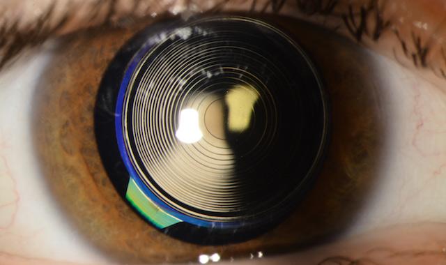Cirugía Facorefractiva en ojo
